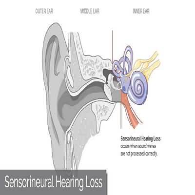sensory hearing losss